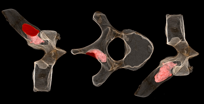 Tumors found on the vertebra of an Australopithecus sediba specimen are shown in pink. (Image: P. S. Randolph-Quinney et al., 2016)